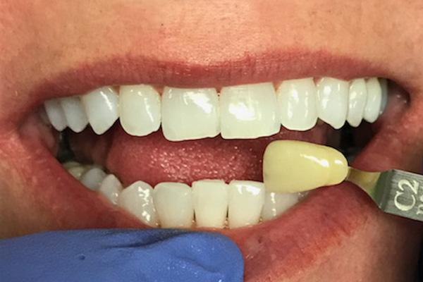 Cosmetic dentistry